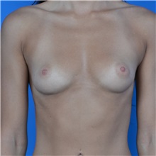 Breast Augmentation Before Photo by Jonathan Weinrach, MD; Scottsdale, AZ - Case 36801