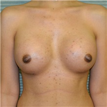 Breast Augmentation After Photo by Jonathan Weinrach, MD; Scottsdale, AZ - Case 36806