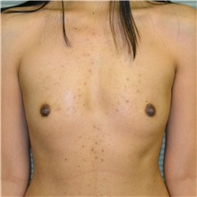 Breast Augmentation Before Photo by Jonathan Weinrach, MD; Scottsdale, AZ - Case 36806