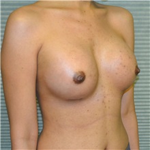 Breast Augmentation After Photo by Jonathan Weinrach, MD; Scottsdale, AZ - Case 36806
