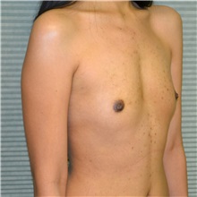 Breast Augmentation Before Photo by Jonathan Weinrach, MD; Scottsdale, AZ - Case 36806