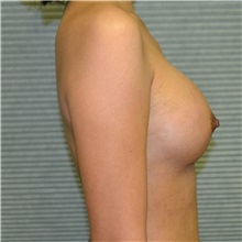 Breast Augmentation After Photo by Jonathan Weinrach, MD; Scottsdale, AZ - Case 36806