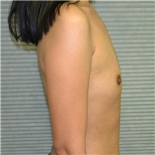 Breast Augmentation Before Photo by Jonathan Weinrach, MD; Scottsdale, AZ - Case 36806