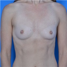 Breast Augmentation Before Photo by Jonathan Weinrach, MD; Scottsdale, AZ - Case 36807