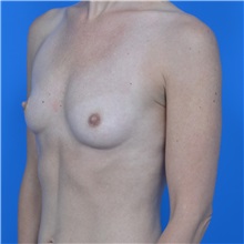 Breast Augmentation Before Photo by Jonathan Weinrach, MD; Scottsdale, AZ - Case 36807