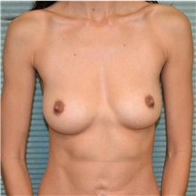 Breast Augmentation Before Photo by Jonathan Weinrach, MD; Scottsdale, AZ - Case 36808