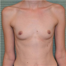 Breast Augmentation Before Photo by Jonathan Weinrach, MD; Scottsdale, AZ - Case 36811