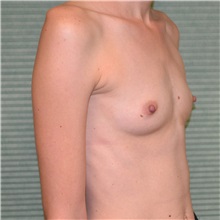 Breast Augmentation Before Photo by Jonathan Weinrach, MD; ,  - Case 36811
