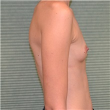 Breast Augmentation Before Photo by Jonathan Weinrach, MD; ,  - Case 36811