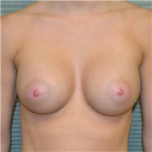 Breast Augmentation After Photo by Jonathan Weinrach, MD; Scottsdale, AZ - Case 36815