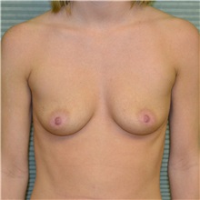 Breast Augmentation Before Photo by Jonathan Weinrach, MD; Scottsdale, AZ - Case 36815