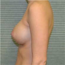 Breast Augmentation After Photo by Jonathan Weinrach, MD; ,  - Case 36815