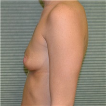 Breast Augmentation Before Photo by Jonathan Weinrach, MD; ,  - Case 36815