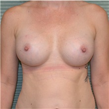 Breast Augmentation After Photo by Jonathan Weinrach, MD; Scottsdale, AZ - Case 36819