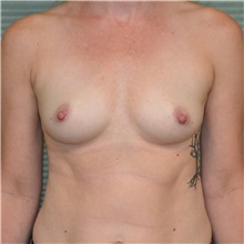 Breast Augmentation Before Photo by Jonathan Weinrach, MD; Scottsdale, AZ - Case 36819