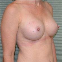 Breast Augmentation After Photo by Jonathan Weinrach, MD; Scottsdale, AZ - Case 36819