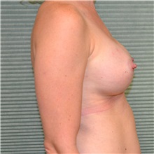 Breast Augmentation After Photo by Jonathan Weinrach, MD; Scottsdale, AZ - Case 36819