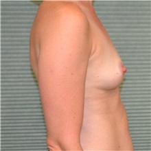 Breast Augmentation Before Photo by Jonathan Weinrach, MD; Scottsdale, AZ - Case 36819
