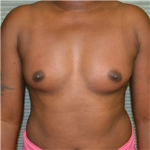 Breast Augmentation Before Photo by Jonathan Weinrach, MD; Scottsdale, AZ - Case 36822