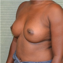 Breast Augmentation After Photo by Jonathan Weinrach, MD; ,  - Case 36822