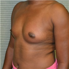 Breast Augmentation Before Photo by Jonathan Weinrach, MD; ,  - Case 36822