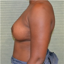 Breast Augmentation After Photo by Jonathan Weinrach, MD; ,  - Case 36822