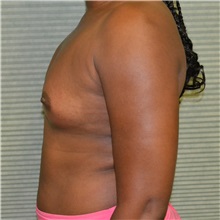 Breast Augmentation Before Photo by Jonathan Weinrach, MD; ,  - Case 36822