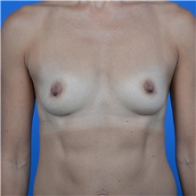 Breast Augmentation Before Photo by Jonathan Weinrach, MD; Scottsdale, AZ - Case 36823
