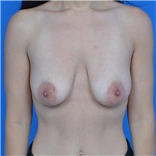 Breast Lift Before Photo by Jonathan Weinrach, MD; Scottsdale, AZ - Case 36828