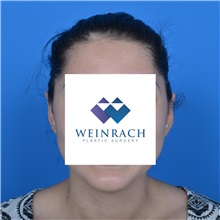 Ear Surgery After Photo by Jonathan Weinrach, MD; Scottsdale, AZ - Case 36835