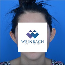 Ear Surgery Before Photo by Jonathan Weinrach, MD; Scottsdale, AZ - Case 36835