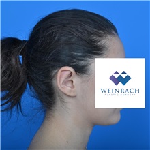 Ear Surgery After Photo by Jonathan Weinrach, MD; ,  - Case 36835