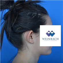 Ear Surgery Before Photo by Jonathan Weinrach, MD; ,  - Case 36835