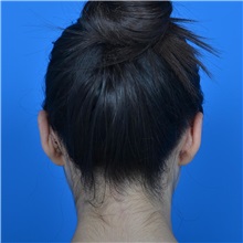 Ear Surgery After Photo by Jonathan Weinrach, MD; ,  - Case 36835