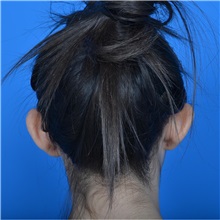 Ear Surgery Before Photo by Jonathan Weinrach, MD; ,  - Case 36835