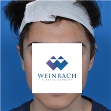 Ear Surgery After Photo by Jonathan Weinrach, MD; Scottsdale, AZ - Case 36836