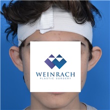 Ear Surgery Before Photo by Jonathan Weinrach, MD; Scottsdale, AZ - Case 36836