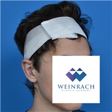 Ear Surgery After Photo by Jonathan Weinrach, MD; ,  - Case 36836