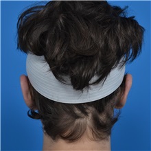 Ear Surgery After Photo by Jonathan Weinrach, MD; ,  - Case 36836