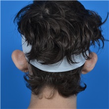 Ear Surgery Before Photo by Jonathan Weinrach, MD; ,  - Case 36836