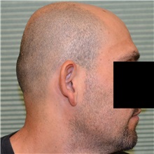 Ear Surgery Before Photo by Jonathan Weinrach, MD; Scottsdale, AZ - Case 36837