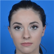 Ear Surgery After Photo by Jonathan Weinrach, MD; Scottsdale, AZ - Case 36839