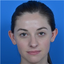 Ear Surgery Before Photo by Jonathan Weinrach, MD; Scottsdale, AZ - Case 36839