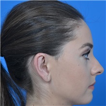 Ear Surgery After Photo by Jonathan Weinrach, MD; ,  - Case 36839