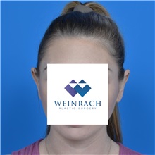 Ear Surgery After Photo by Jonathan Weinrach, MD; Scottsdale, AZ - Case 36841