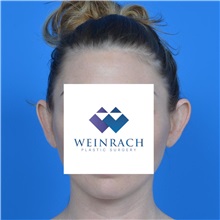 Ear Surgery Before Photo by Jonathan Weinrach, MD; Scottsdale, AZ - Case 36841