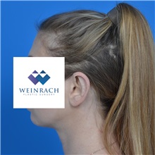 Ear Surgery After Photo by Jonathan Weinrach, MD; Scottsdale, AZ - Case 36841