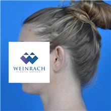 Ear Surgery Before Photo by Jonathan Weinrach, MD; Scottsdale, AZ - Case 36841