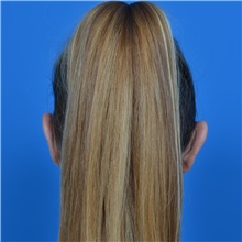 Ear Surgery After Photo by Jonathan Weinrach, MD; Scottsdale, AZ - Case 36841