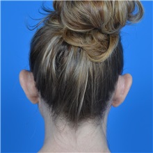 Ear Surgery Before Photo by Jonathan Weinrach, MD; Scottsdale, AZ - Case 36841